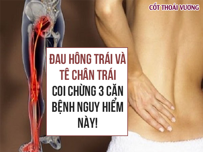 Đau Hông Trái Và Tê Chân Trái – Coi Chừng 3 Căn Bệnh Nguy Hiểm Này!